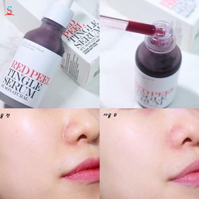 Serum tái tạo Red Peel Tingle So natural - Hàn Quốc 3
