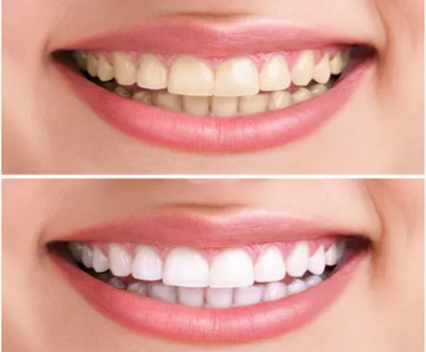Các loại kem đánh răng tốt nhất hiện nay