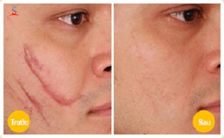 Kem trị sẹo Gentacin Nhật Bản 2