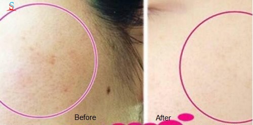 Tinh chất đặc trị nám mụn CC Melano 3