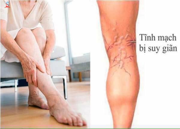Kem Varikosette điều trị giãn tĩnh mạch 3