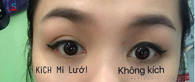 kích mí lưới Keli 2