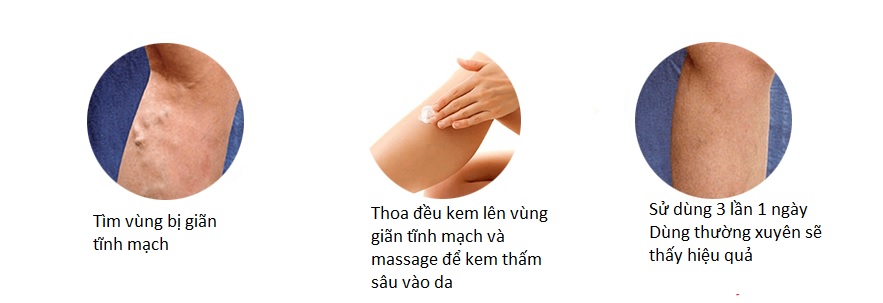 Kem Varikosette điều trị giãn tĩnh mạch 4