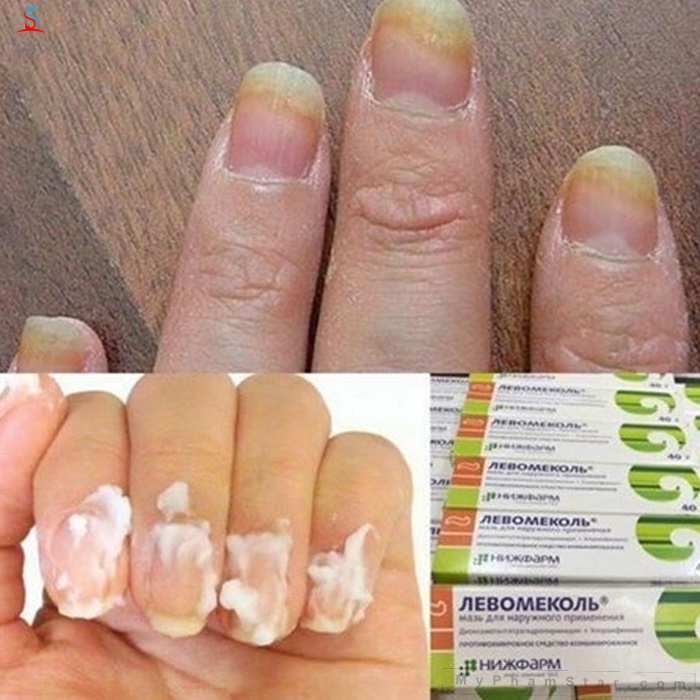 Kem trị á sừng vảy nến Levomekol Nga 2