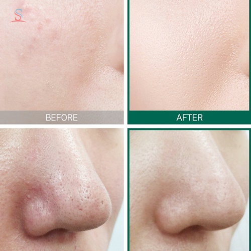  Bộ Kit Trị Mụn Some By Mi AHA- BHA-PHA 30 Days Miracle Set 3