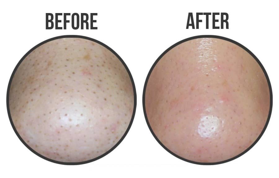 Mặt Nạ Đẩy Mụn Đầu Đen Good-Bye Blackhead Ciracle 6