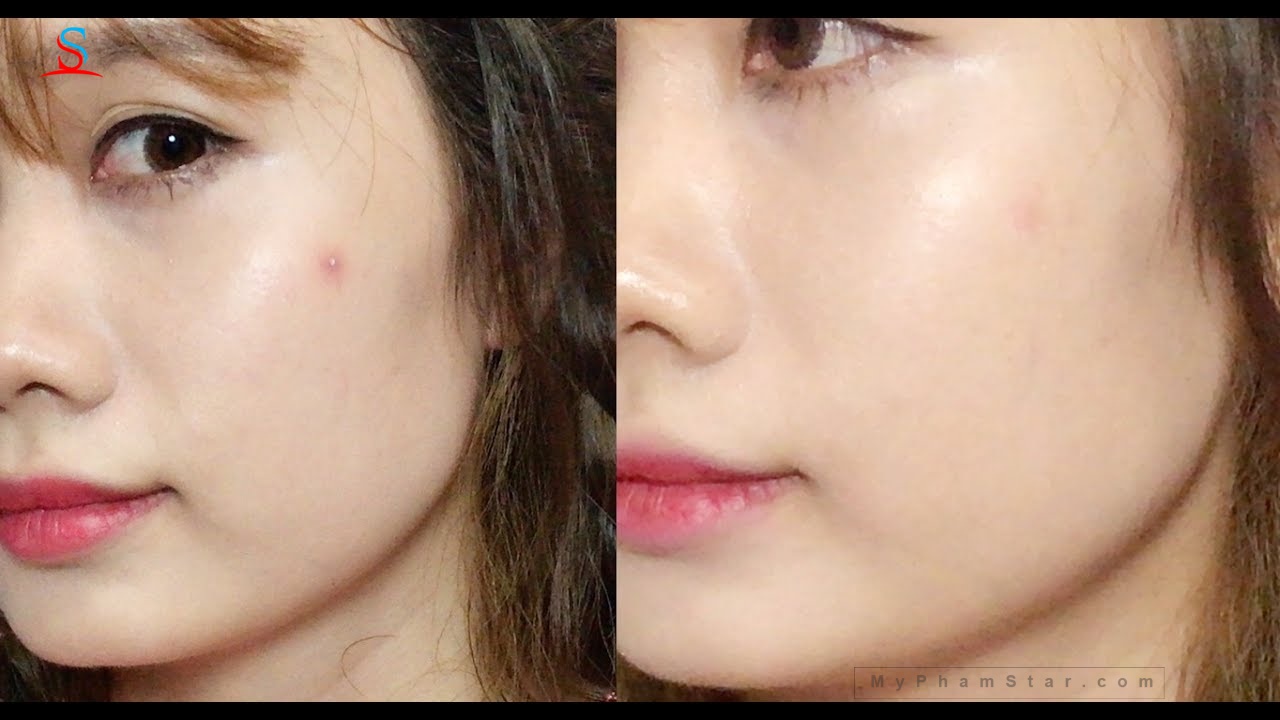 Miếng dán mụn cosrx 3