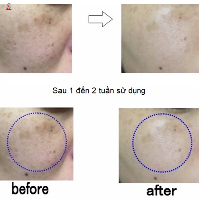 Kem trị nám H2 Skin Spot Cream Nhật 3