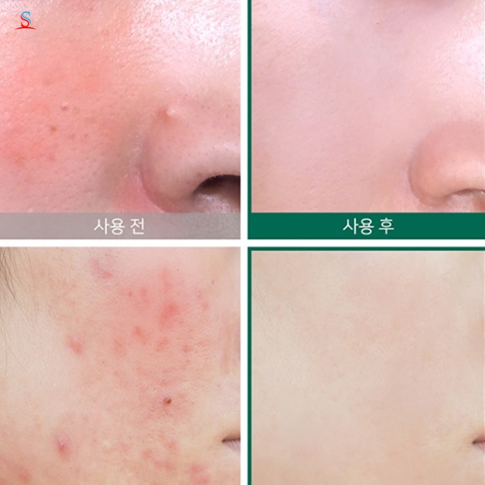 Tinh chất Trị Mụn Some By Mi AHA-BHA-PHA 30 Days Miracle Serum 4